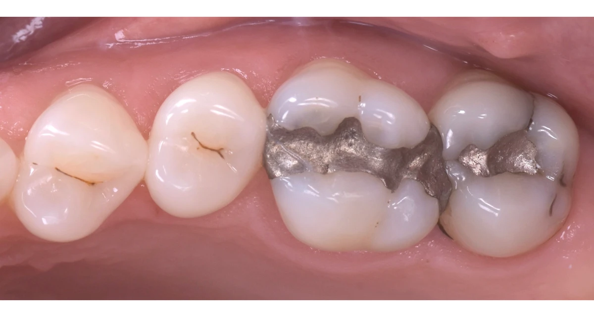 Les colorations dentaires et usures dentaires