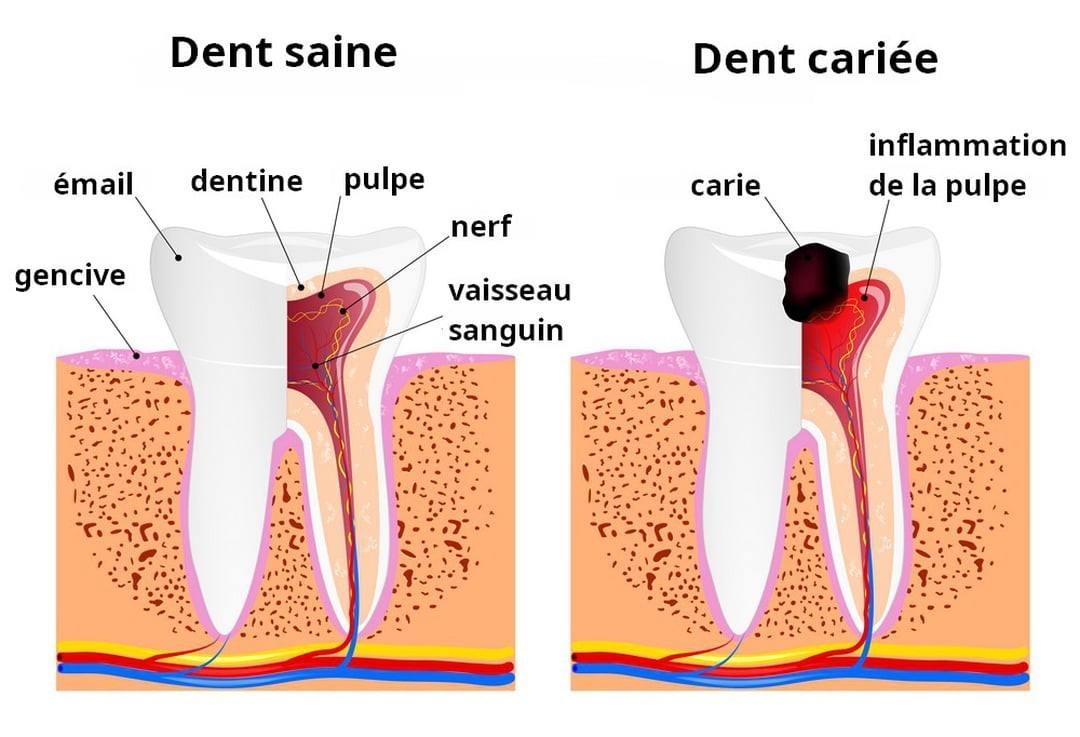 Le traitement endodontique