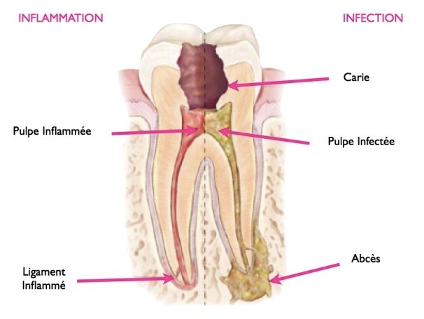 Le traitement endodontique