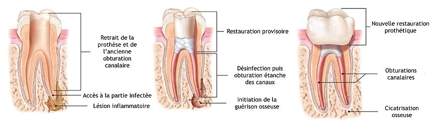 Le retraitement endodontique
