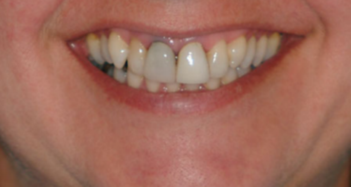 Pose d'implants dentaires