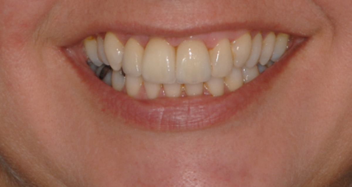 Pose d'implants dentaires