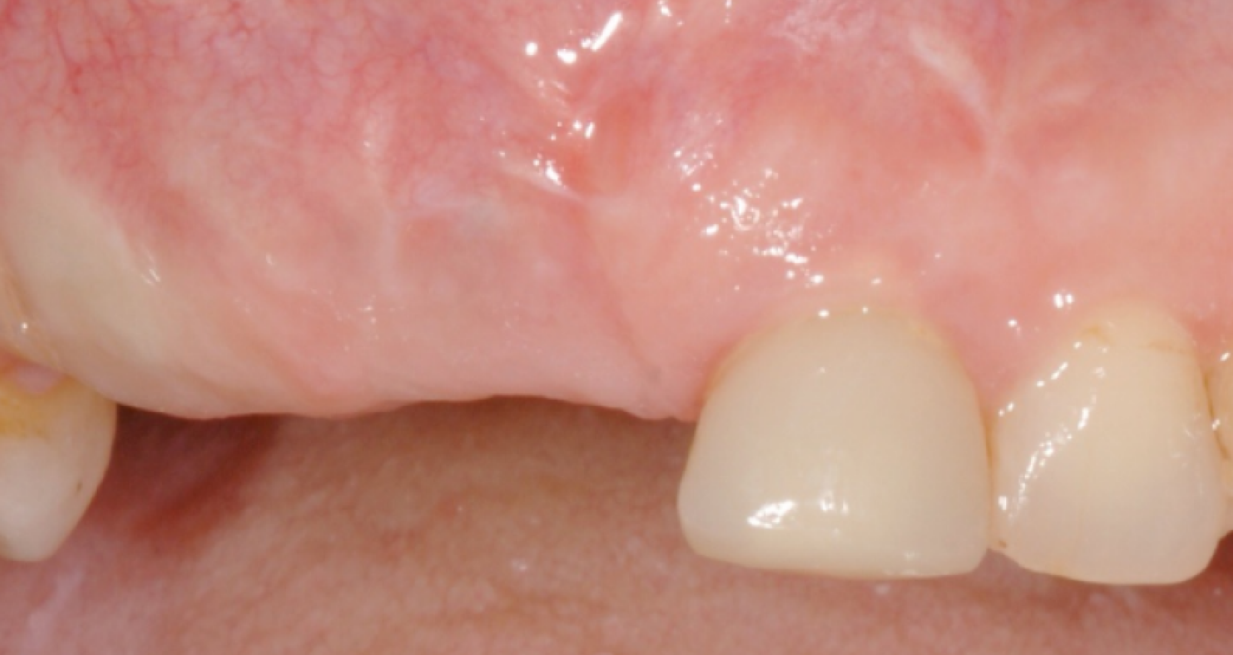 Pose d'implants dentaires