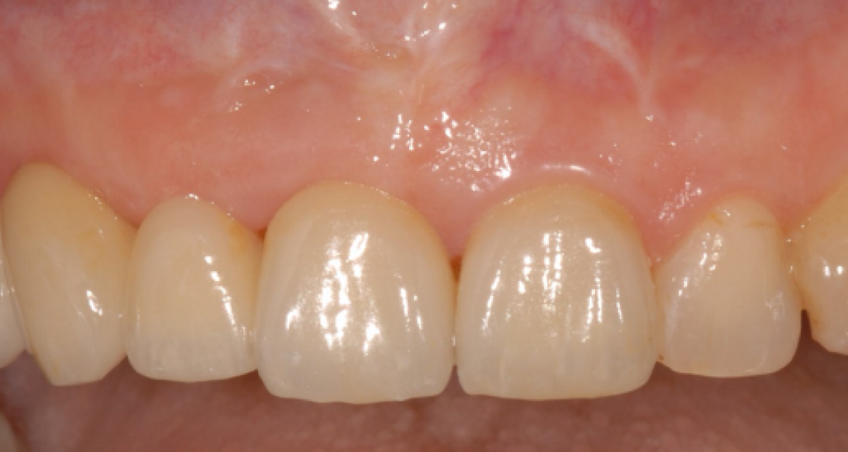 Pose d'implants dentaires