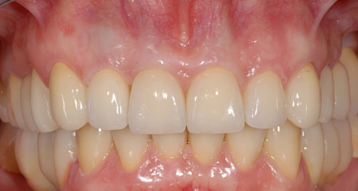 Pose d'implants dentaires