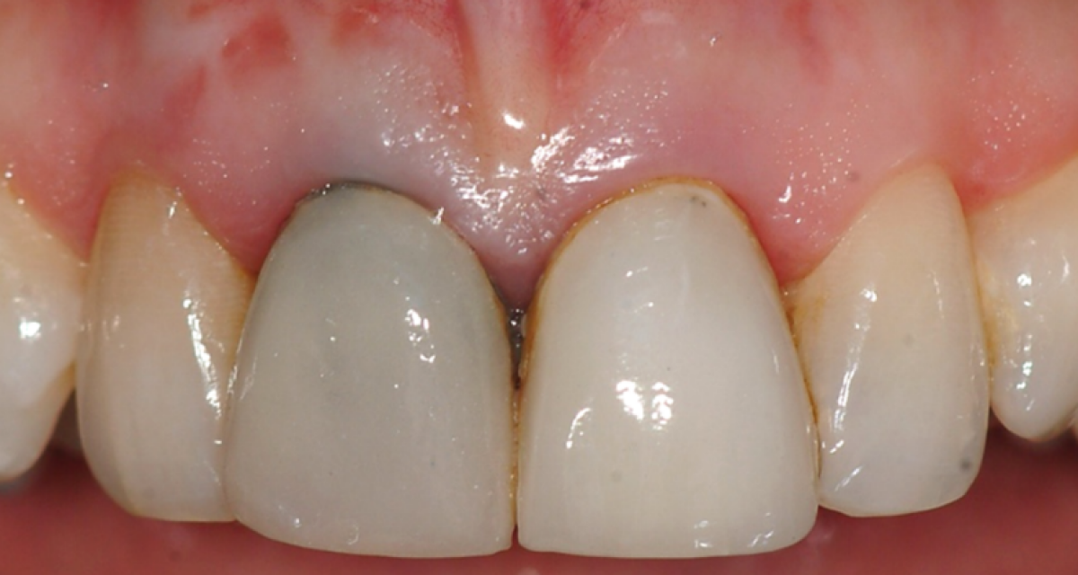 Pose d'implants dentaires