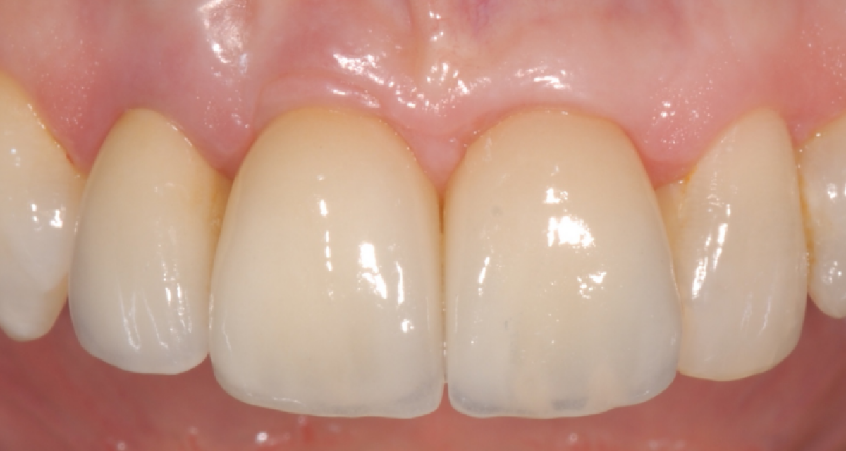 Pose d'implants dentaires