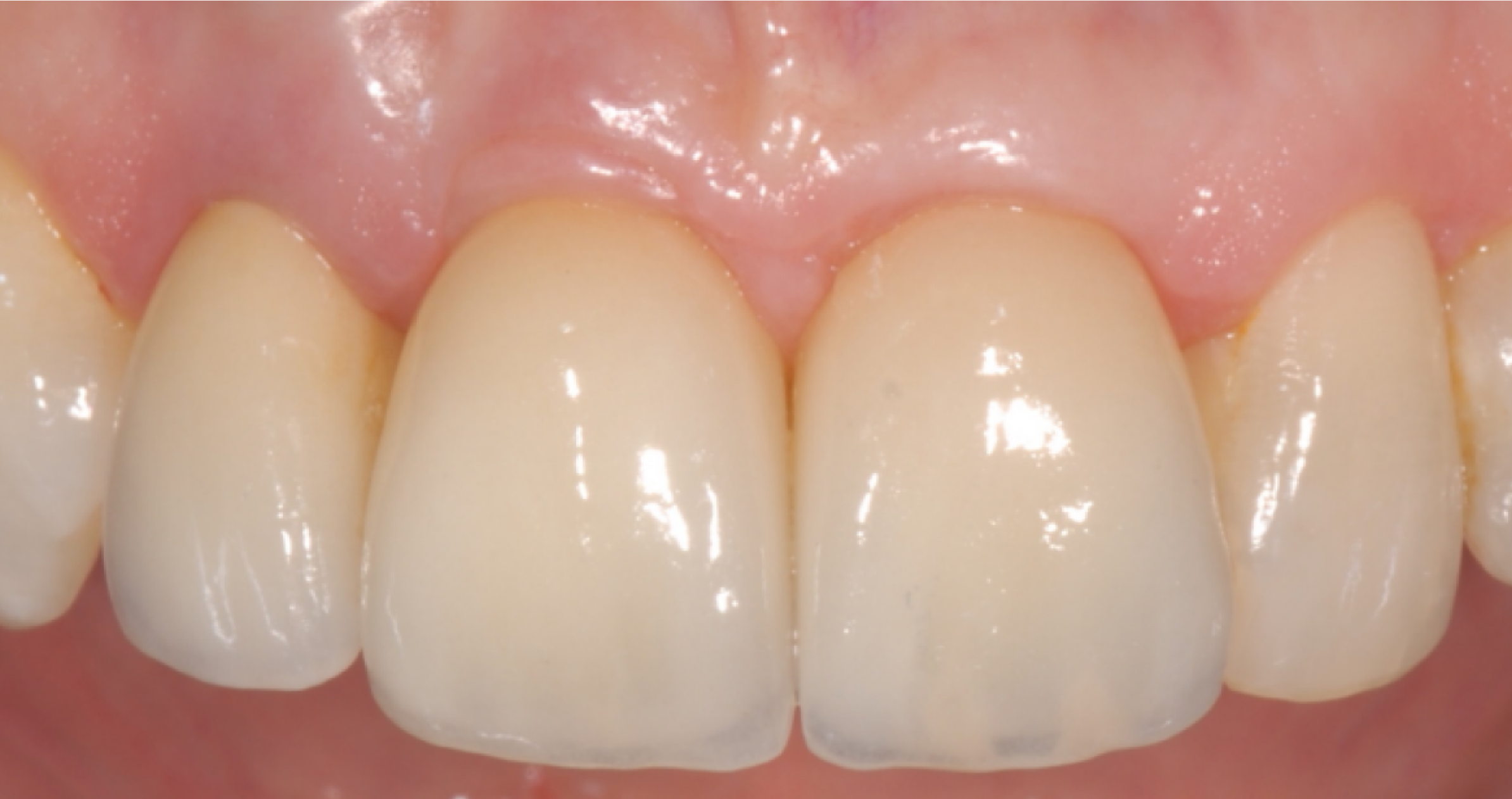 Pose d'implants dentaires