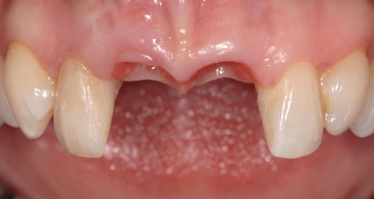 Pose d'implants dentaires