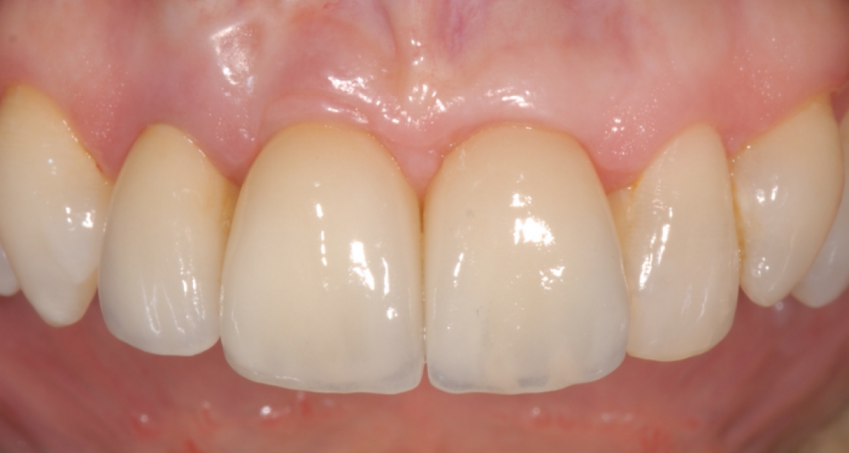 Pose d'implants dentaires