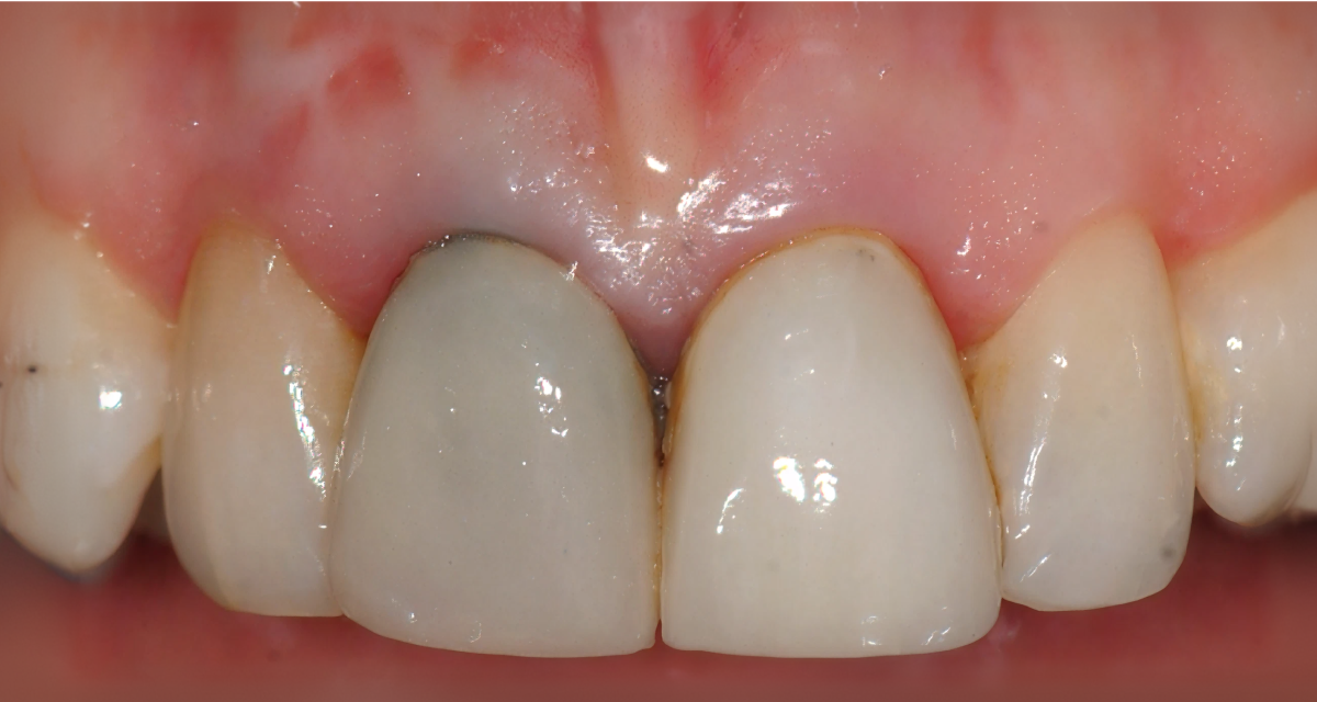 Pose d'implants dentaires