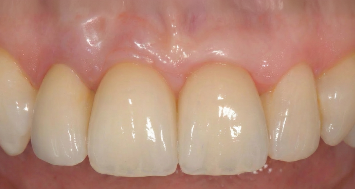 Pose d'implants dentaires