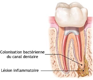 Le retraitement endodontique