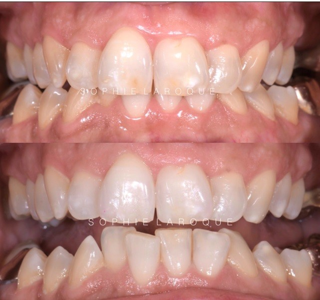 L’éclaircissement dentaire Dentiste Le Drs & Associés