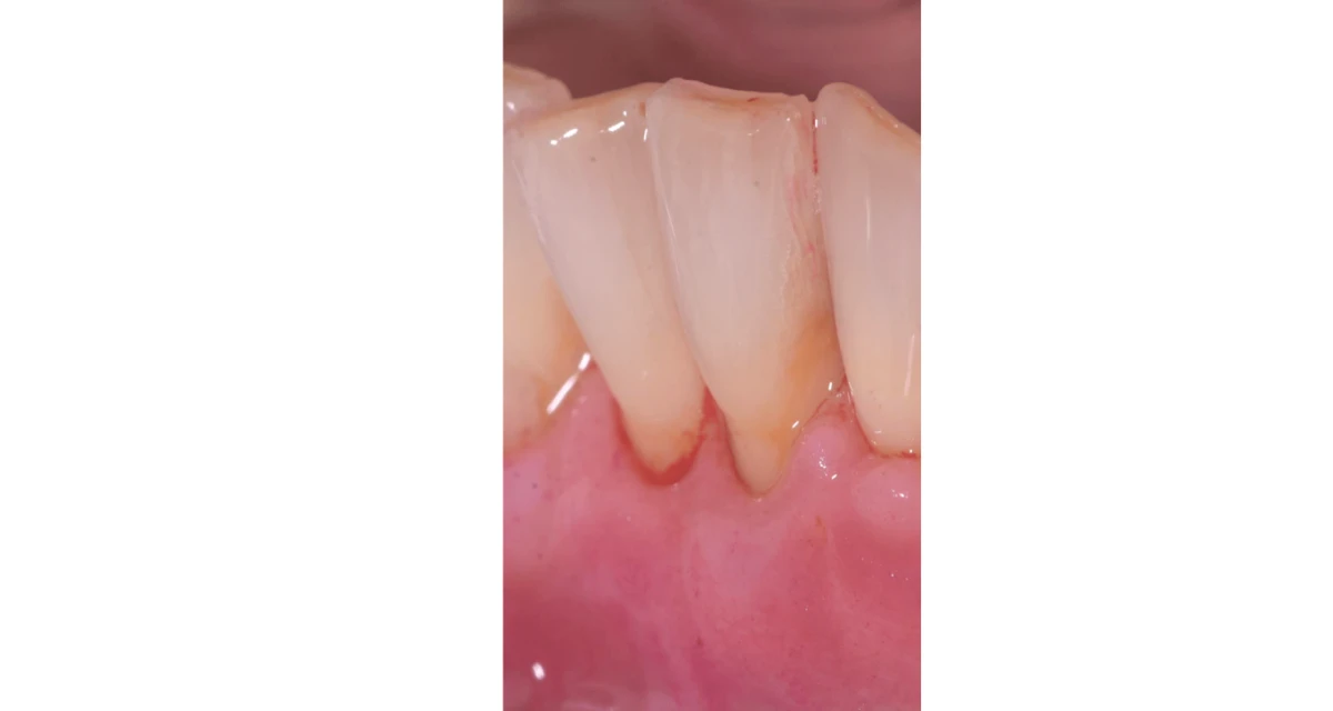 La chirurgie mucco-gingivale ou chirurgie plastique parodontale