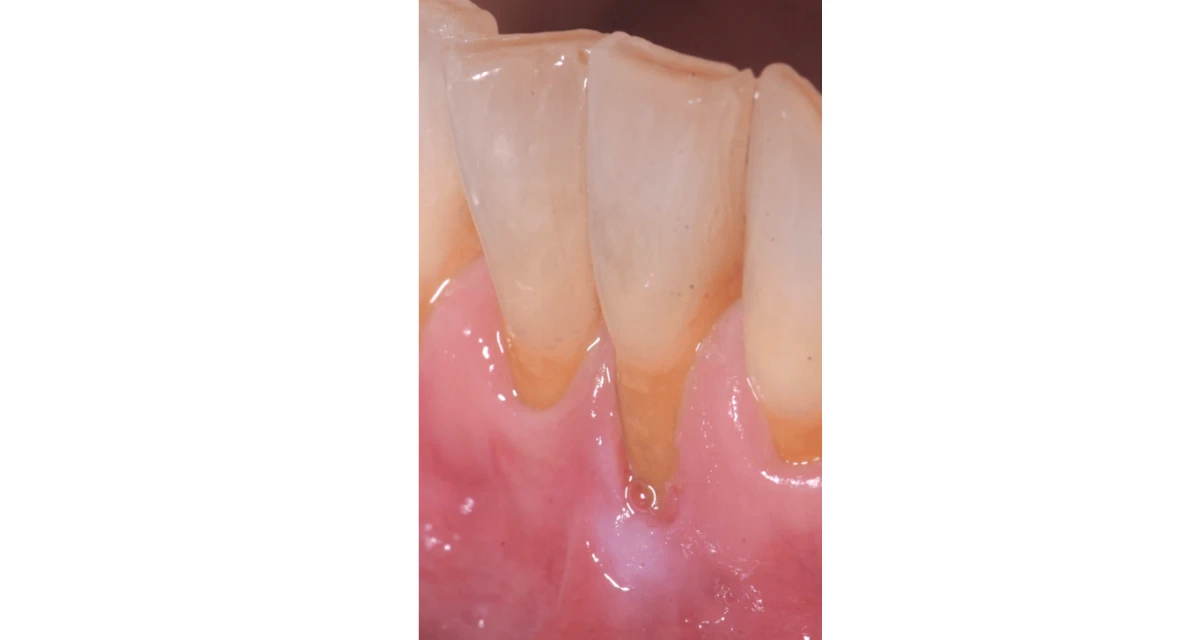 La chirurgie mucco-gingivale ou chirurgie plastique parodontale