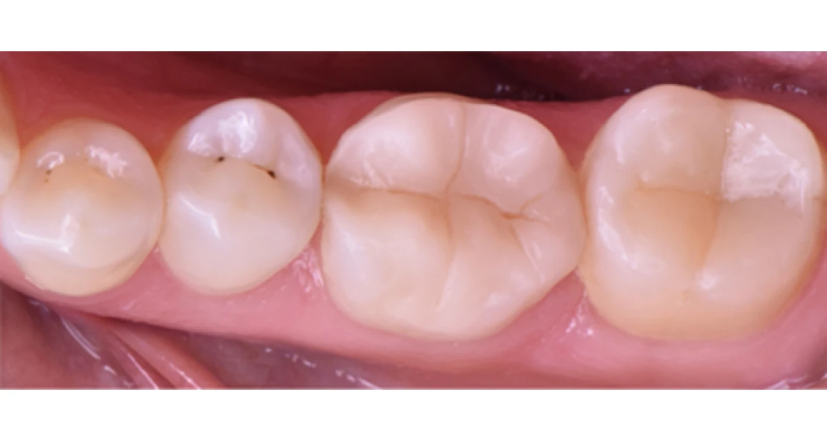 Direct and indirect aesthetic restorations