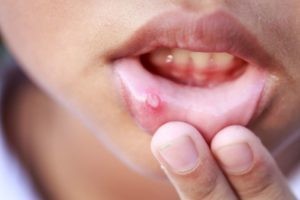 How to treat a canker sore ?